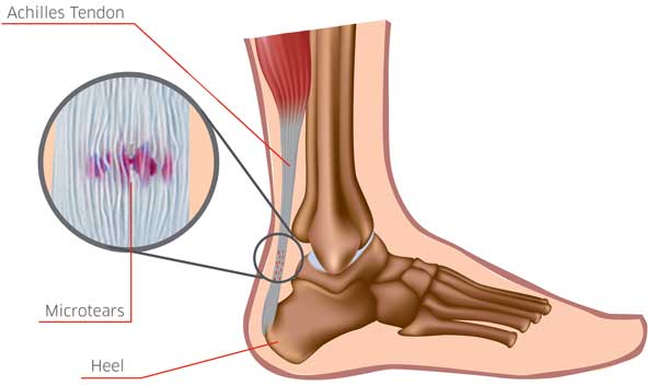 achilles-tendonitis