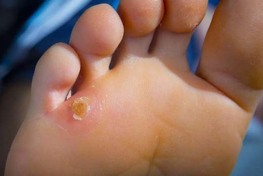 blisters-on-feet